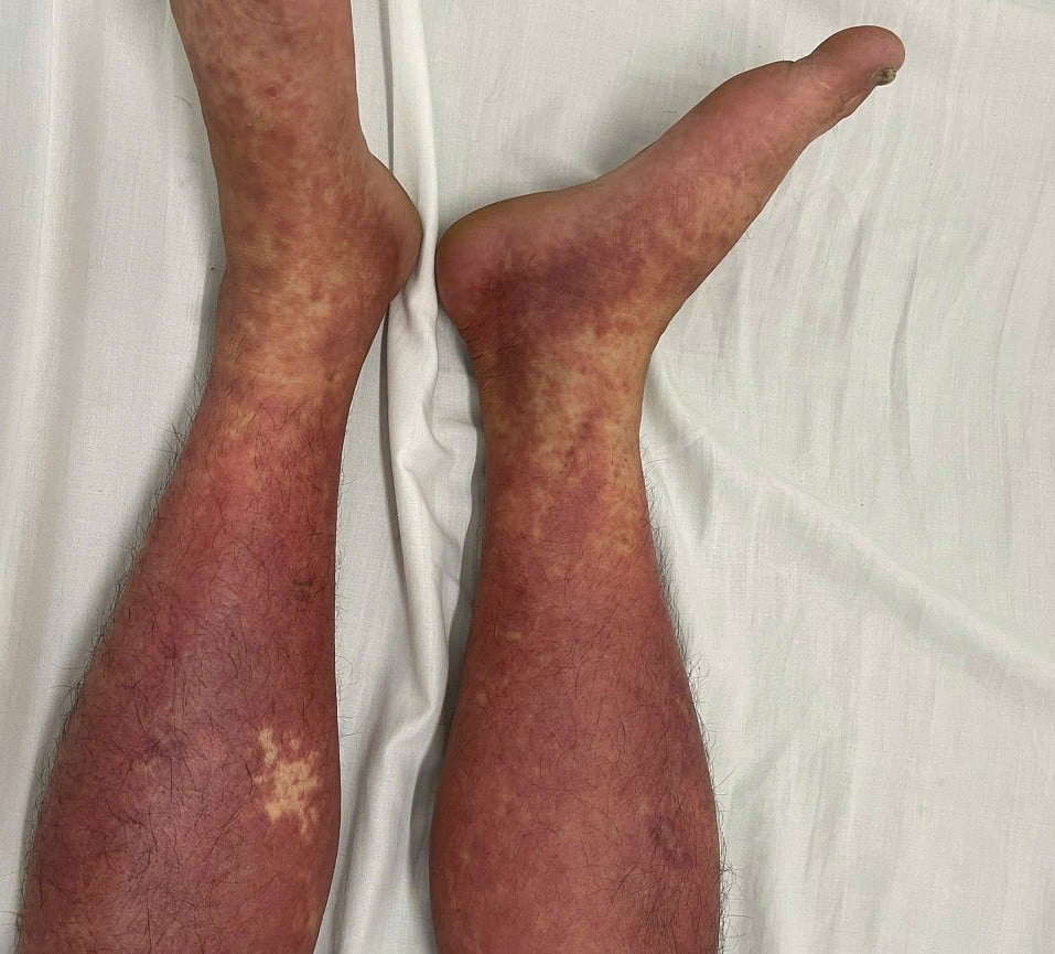  Hình ảnh phát ban toàn thân trên bệnh nhân dị ứng thuốc nặng do Phenylbutazone đang được điều trị tại Trung tâm Dị ứng & Miễn dịch lâm sàng - Ảnh BVCC
