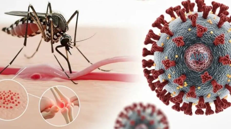  Chikungunya là bệnh do virus Chikungunya, được lây truyền qua muỗi Aedes.