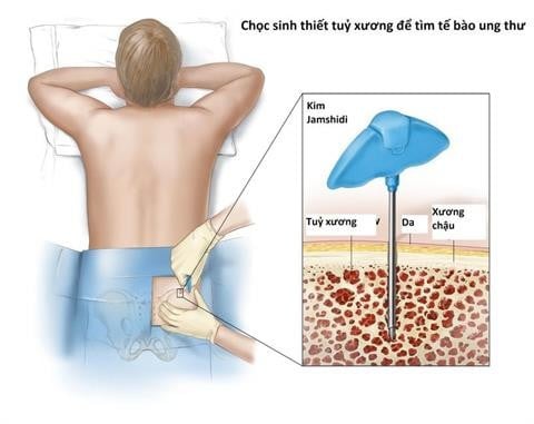  Chọc sinh thiết xương để chẩn đoán - Ảnh minh họa nguồn Internet