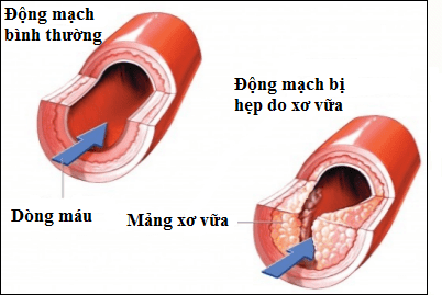  Xơ vữa động mạch làm tăng nguy cơ hình thành cục máu đông, dẫn đến nhồi máu cơ tim và tai biến mạch máu não.