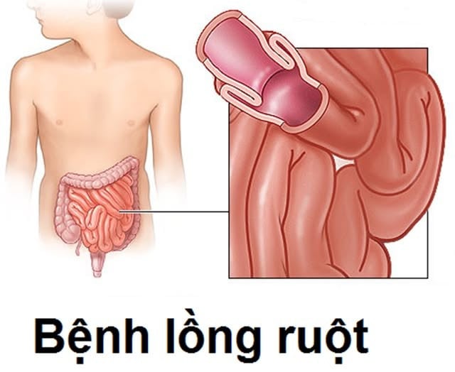 Ảnh minh họa BVCC