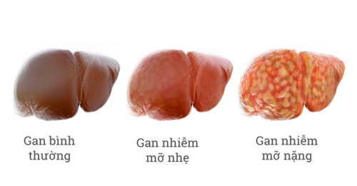 Các giai đoạn của gan nhiễm mỡ.