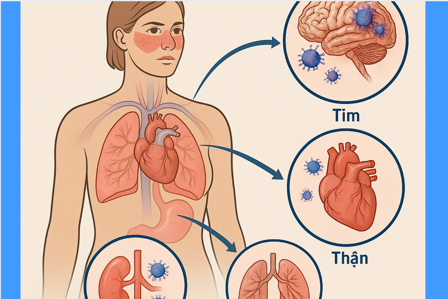 Hệ miễn dịch bị rối loạn trong lupus có thể gây viêm và tổn thương toàn thân như thận, tim, phổi, não…