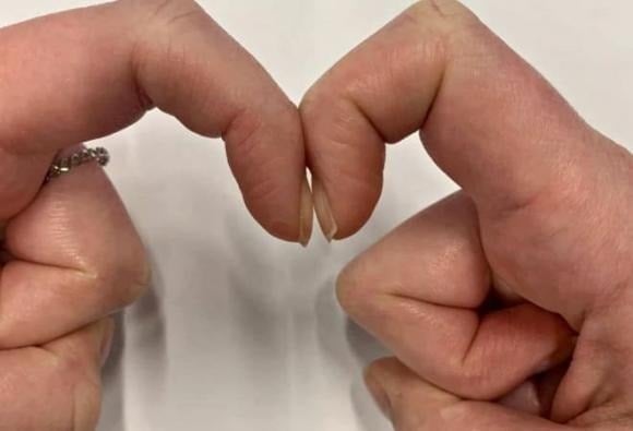 Thống kê cho thấy khoảng 30% bệnh nhân ung thư phổi có dấu hiệu này.