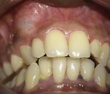 Nang xương hàm - Ảnh BSCC