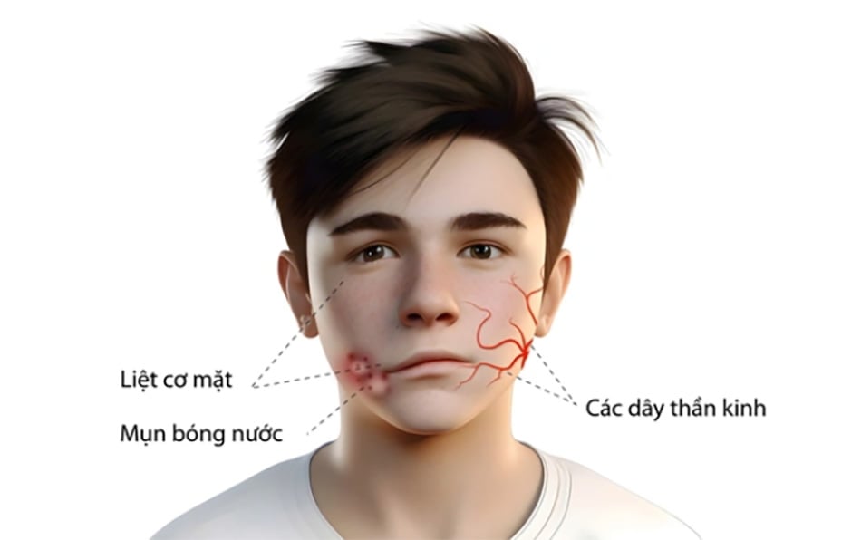 Bệnh zona thần kinh ở mặt tiềm ẩn nhiều nguy cơ bệnh lý nghiêm trọng hơn so với zona ở các vị trí khác trên cơ thể.