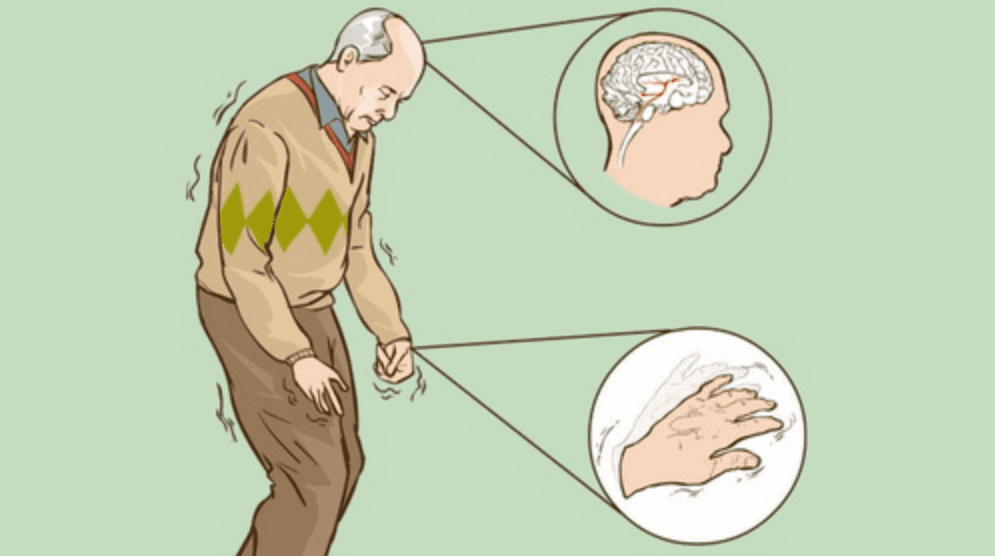 Các dấu hiệu ban đầu của bệnh Parkinson thường âm thầm và dễ bị bỏ qua nếu không chú ý.