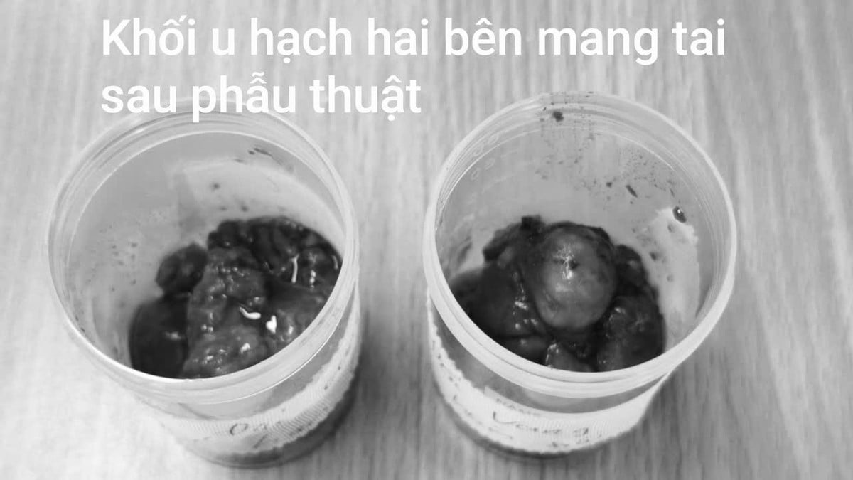 Khối u hạch hai bên được lấy ra - Ảnh BVCC