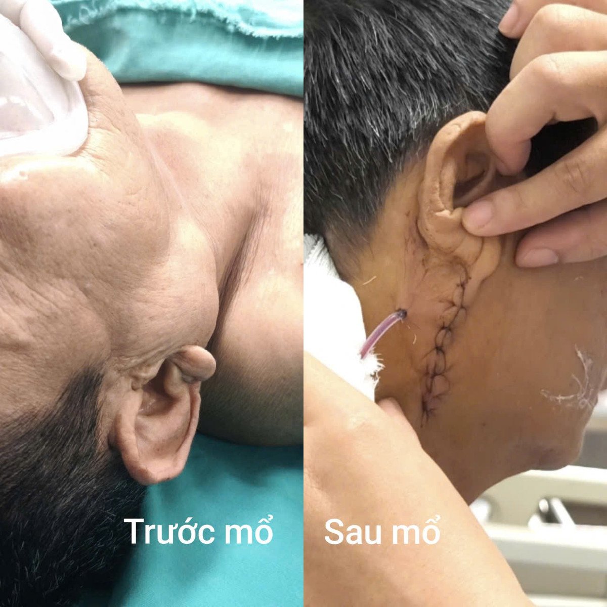 Hình ảnh khối u trước và sau mổ - Ảnh BVCC