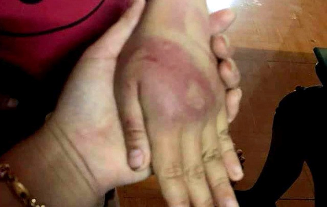 Bàn tay cháu bé cũng có nhiều vết bầm tím do bị đánh.