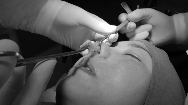  Sống mũi nhân tạo được rút ra ngoài, máu mủ trào ra trong quá trình can thiệp
