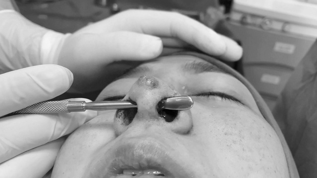  Vách ngăn mũi của bệnh nhân bị xuyên thủng do nhiều lần bị những người thiếu chuyên môn phẫu thuật