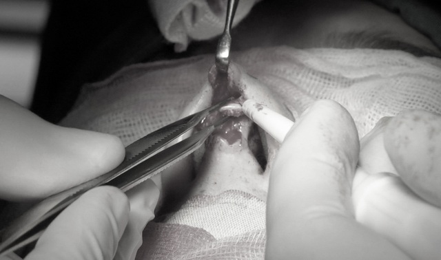  Các bác sĩ đã phải thực hiện cuộc phẫu thuật xử lý ổ nhiễm trùng sau nâng mũi cho bệnh nhân