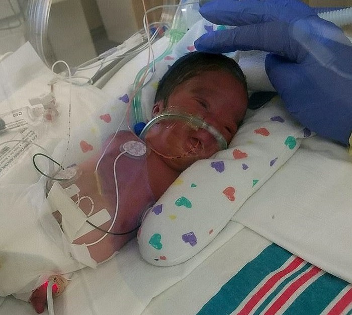 Em bé phải nằm trong phòng chăm sóc đặc biệt 2 tháng sau khi sinh 