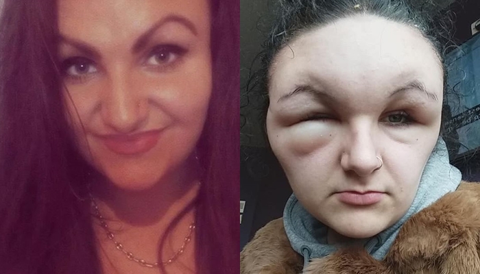 Khuôn mặt của Georgina trước và sau khi dị ứng thuốc nhuộm tóc. (Ảnh: The Sun) 