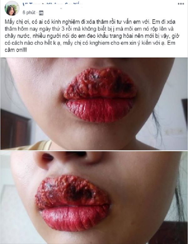 Sau 3 ngày thực hiện xóa thâm, môi của cô gái trẻ đã bị nhiễm trùng trông thật đáng sợ. 