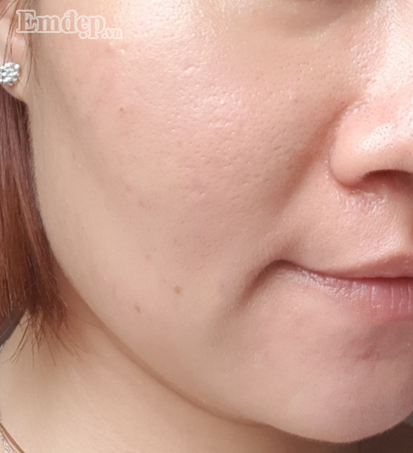 Làn da sạch mụn nội tiết của chị Nguyen Trang khiến nhiều người ngưỡng mộ. 