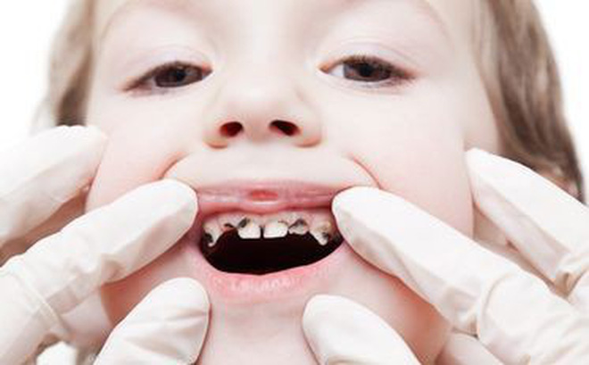 Bú bình, ngậm ti giả không đúng cách khiến trẻ bị mòn răng, ảnh hưởng đến việc nhai thức ăn thô. Ảnh: Internet